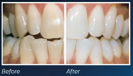 Weiße Zähne sind mit einem Bleaching in der Zahnarztpraxis Kristin Börner in Berlin kein Problem!